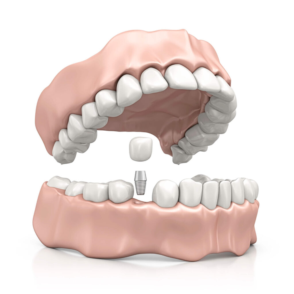 Dental implant procedure at EOS Oral Surgery in the Twin Cities.